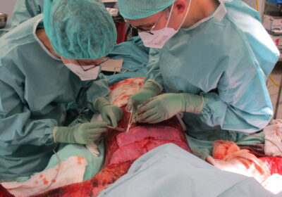 Bei einer Operation transplantieren zwei Ärzte Spenderhaut an einem Oberkörper eines verbrannten jungen Mannes.