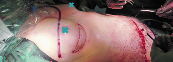 Eine Brustrekonstruktion mit Eigengewebe aus dem Bauch